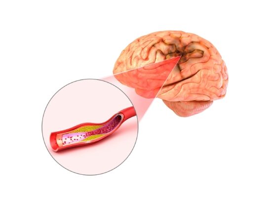 Attacchi ischemici transitori